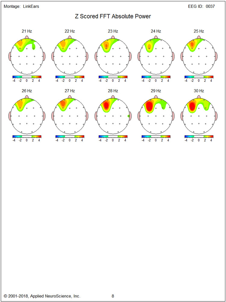 Figure 17 - Post-neurofeedback eyes-closed z-score FFT absolute power single-Hz bins 21-30 Hz